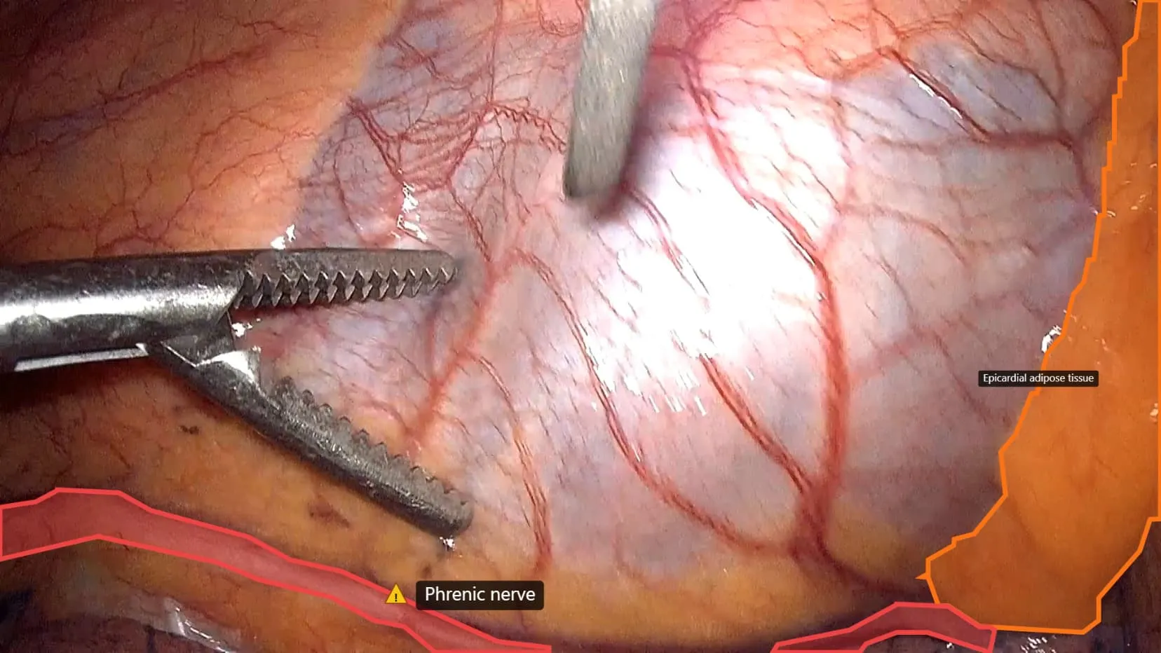 CardioVis-guided view with hazard overlays